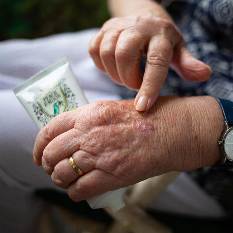 Douleurs articulaires de la main liées à l’arthrite ou à l’arthrose, avec application d’un soin naturel